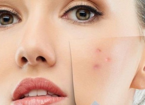 rimedi per le cicatrici da acne