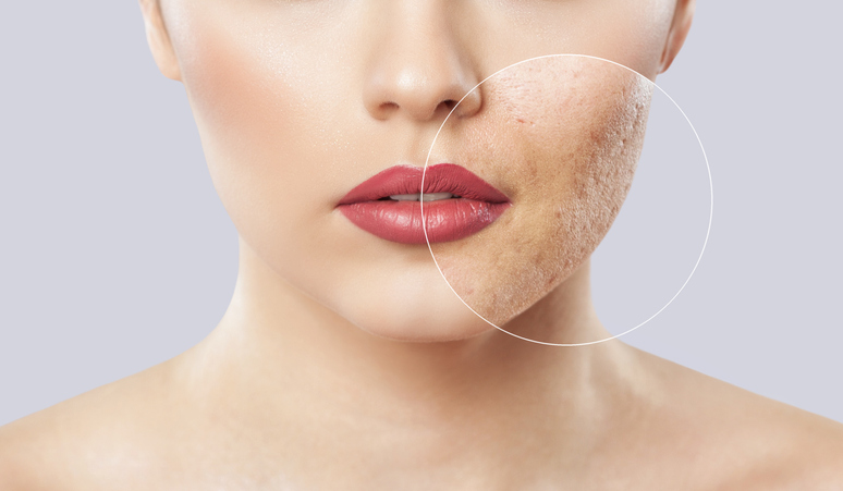 Cicatrici acne: soluzione Dermapen